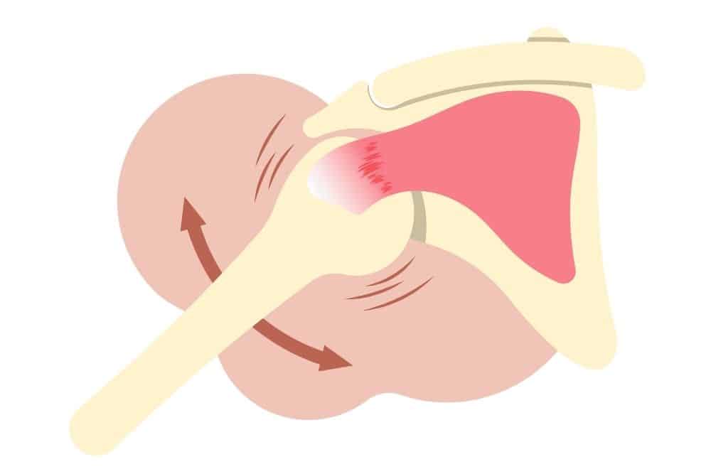 Tratamiento para la capsulitis en el hombro: cómo aliviar el dolor y recuperar la movilidad / Clínica de fisioterapia Recuperate